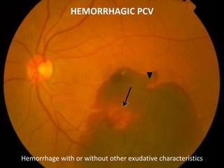 HEMORRHAGIC PCV
Hemorrhage with or without other exudative characteristics
 