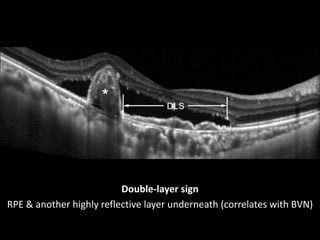 Double-layer sign
RPE & another highly reflective layer underneath (correlates with BVN)
 