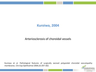 Kuroiwa, 2004
Arteriosclerosis of choroidal vessels
Kuroiwa et al. Pathological features of surgically excised polypoidal choroidal vasculopathy
membranes. Clin Exp Ophthalmol 2004;32:297-302.
 