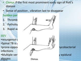 Left Clonus Pott's disease- tuberculosis of the spine | PPTX