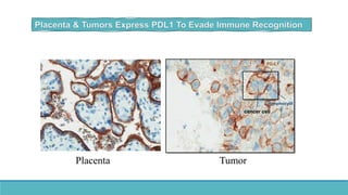 cancer cell
PD-L1
lymphocyte
Placenta Tumor
 