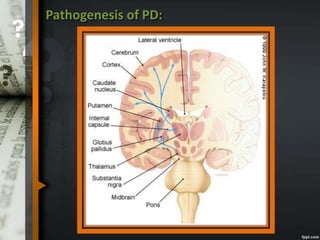 Pathogenesis of PD:
 