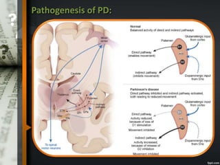 Pathogenesis of PD:
 