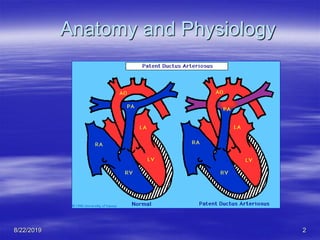 Patent Ductus Arteriosus on the Newborn | PDF