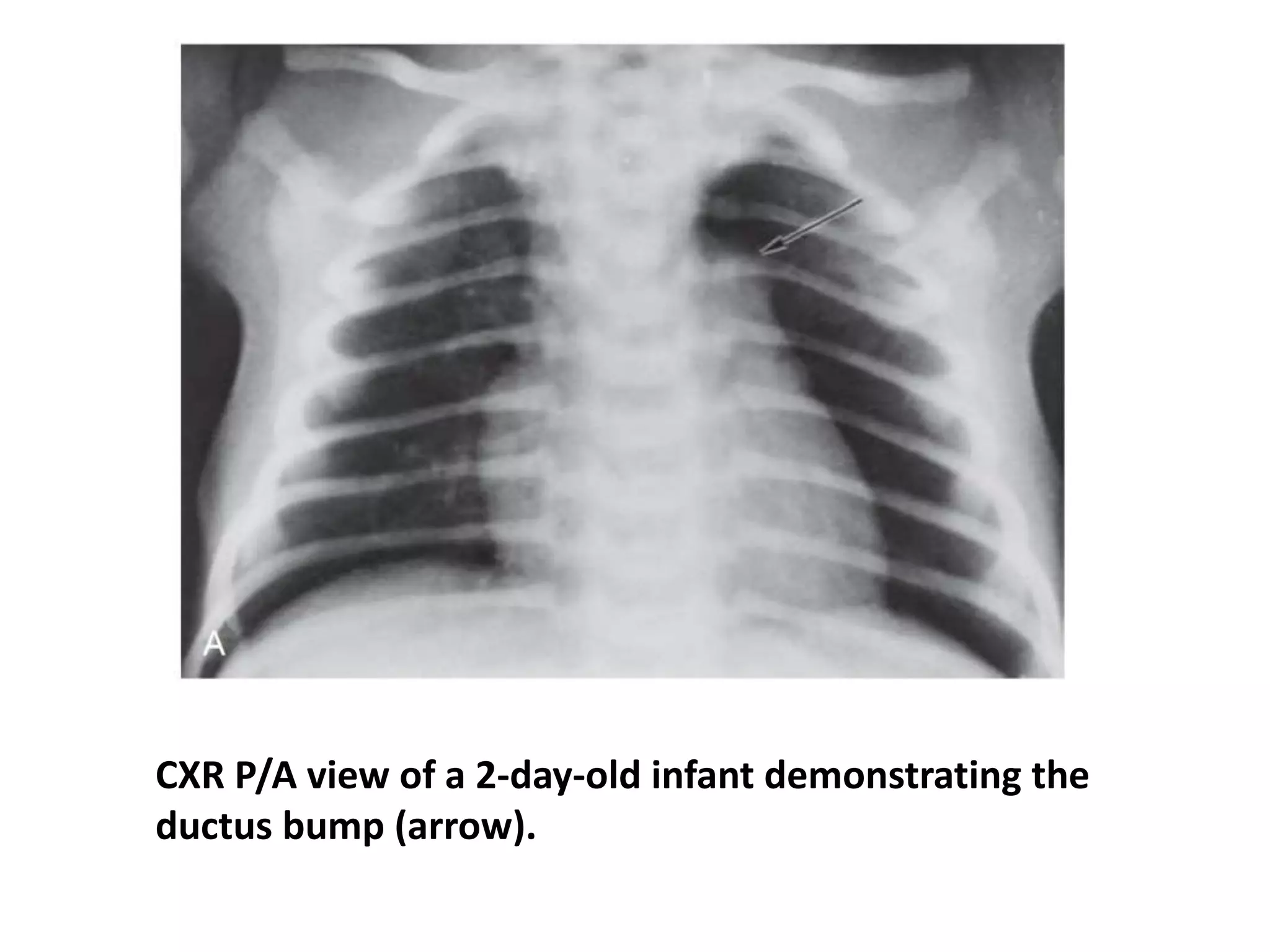 Pda Radiographs Patent Ductus Arteriosus (PDA) | PPTX