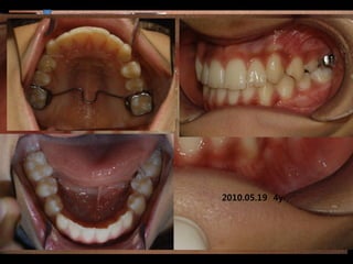 2009.03.06 2y 4y
         2010.05.19 9m
             2008.12.10.2y6m
        2009.07.08 3y 1m 2m,
             2008.07.30.2y
2009.09.18 2006.06.07
           TPA2006.10.11 4m
      2009.10.22 3y 4m 7m
         2010.01.27. 4y 1y2m
                2007.08.01
 