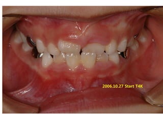 2006.10.27 Start T4K
 