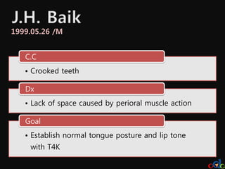 1999.05.26 /M


   C.C
   • Crooked teeth

   Dx
   • Lack of space caused by perioral muscle action

   Goal
   • Establish normal tongue posture and lip tone
    with T4K
 