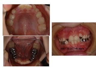 2007.10.21 T4K start
 