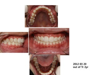 2012 03 20
out of Tr 2yr
 