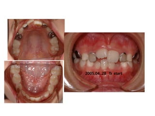 2005.04..28 Tr start
 