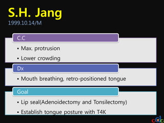 S.H. Jang
1999.10.14/M

   C.C
   • Max. protrusion
   • Lower crowding
   Dx
   • Mouth breathing, retro-positioned tongue

   Goal
   • Lip seal(Adenoidectomy and Tonsilectomy)
   • Establish tongue posture with T4K
 