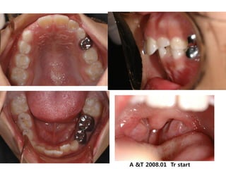 A &T 2008.01 Tr start
 