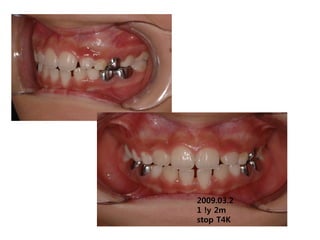 2009.03.2
1 !y 2m
stop T4K
 