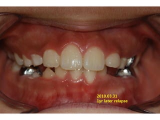 2010.03.31
1yr later relapse
 