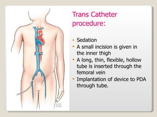 Trans Catheter procedure: Sedation  A small incision is given in  the inner thigh A long, thin, flexible, hollow tube is inserted through the femoral vein Implantation of device to PDA through tube. 