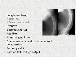  Long bones bend
 Tibia –Ant
 Femur – Antlateral
 Kyphosis
 Becomes shorter
 Ape like
 Arms hanging infront
 Cranial nerve/spinal cord/nerve root
compression
 Pathological #
 Cardiac failure-high output
 