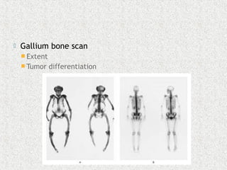  Gallium bone scan
 Extent
 Tumor differentiation
 