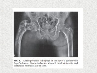 paget's disease