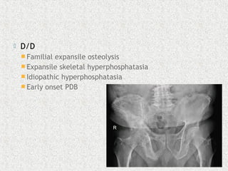  D/D
 Familial expansile osteolysis
 Expansile skeletal hyperphosphatasia
 Idiopathic hyperphosphatasia
 Early onset PDB
 