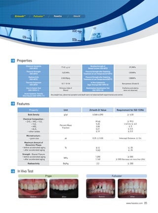 Properties
           Chemical Solubility                                                             Bonding Strength of
                                                       17.42 ㎍/㎠                                                                              29.2MPa
              (ISO 6872)                                                                 Dental Ceramic (ISO 6872)
           Flexural Strength                                                          Flexural Strength after Depleting
                                                        1420 MPa                                                                             1392MPa
               (ISO 6872)                                                          treatment at Low temperature(130°C)
              Radioactivity                                                           Flexural Strength after Depleting
                                                       0.0022Bp/g                                                                            1288MPa
               (ISO 6872)                                                          treatment at Low temperature(200°C)
           thermal expansion                                                                In Vitro Cytotoxicity
                                                       10.7 10-6/K                                                                   Noncytotoxic (Grade 0)
               (ISO 6872)                                                               (Agar Overlay) (ISO 10993-5)
           Oral Irritation test                     Stimulus Index 0                   maximization Sensitization test               Erythema and edema
             (ISO 10993-1)                              (None)                                (ISO 10993-10)                          were not observed.
         Acute Systemic toxicity
                                          Any weight loss, abnormal symptom and death were not observed both experimental and control.
       (Oral Route) (ISO 10993-11)



   Features
               Property                                   Unit                             Zirtooth Zr Value                 Requirement for ISO 13356
             Bulk Density                                 g/㎤                                  6.068~6.090                                  ≥ 6.00

       Chemical Composition :
         • ZrO + HfO + Y O
               2        2 2 3                                                                      99.60                                   ≥ 99.0
                  • Y O                                                                            5.35                                  ＞4.5 to ≤ 6.0
                     2 3
                                                     Percent Mass
                 • HfO                                                                             3.00                                      ≤5
                        2
                                                       Fraction
                 • Al O
                      2 3                                                                          0.21                                     ≤ 0.5
            • other oxides                                                                         0.19                                     ≤ 0.5

           Microstructure :
             • grain size                                  ㎛                                   0.25 ± 0.05                       Intercept Distance ≤ 0.4

          Maximum Amount of
           Monoclinic Phase:
       • before accelerated aging                          %                                       8.12                                      ≤ 20
        • after accelerated aging                                                                  15.82                                     ≤ 25
       Strength : Biaxial Flexure
       • before accelerated aging                                                                  1,200                                 ≥ 500
                                                          MPa
        • after accelerated aging                                                                  1,140                    ≥ 500 (Decrease not more than 20%)

             Radioactivity                               Bq/kg                                      2.2                                     ≤ 200


> In Vivo Test
                                     P type                                                                              Fulluster




                Before                                  After                                          Before                                  After


                                                                                                                                           www.hassbio.com    05
 