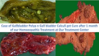 Gall bladder Polyp, Gall stone & Homoeopathy