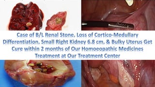 Renal Stones, Loss of Cortico-Medullary Differentiation, Bulky Uterus & Homoeopathy