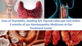 Case of Thyroiditis, Swelling B/L Thyroid Lobes & Homoeopathy