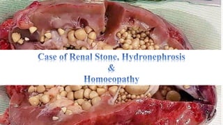 Renal Stone, Hydronephrosis & Homoeopathy (गुर्दे की पथरी, किडनी स्टोन का सफल होम्योपैथी उपचार)
