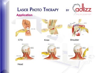 Application




 CTS          Knee   Shoulder




Head
 