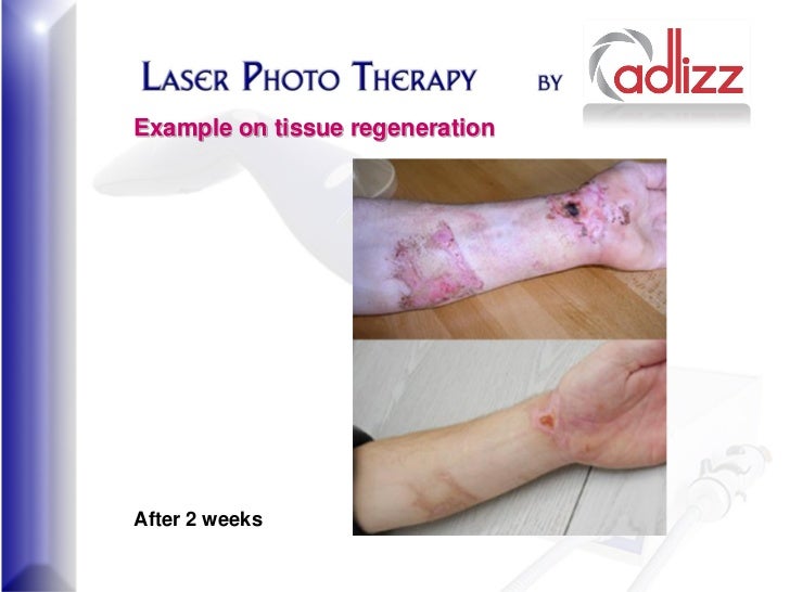Laser Phototherapy
