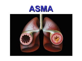 Pdf asma compress | PDF