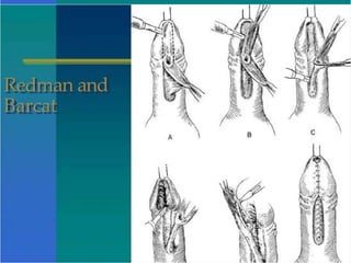 Redman and
Barcat
 