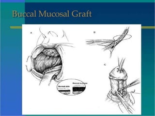 Buccal Mucosal Graft
 