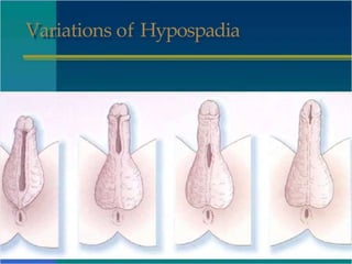 Variations of Hypospadia
 