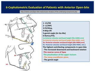 Pdf- open-bite-malocclusion | PDF
