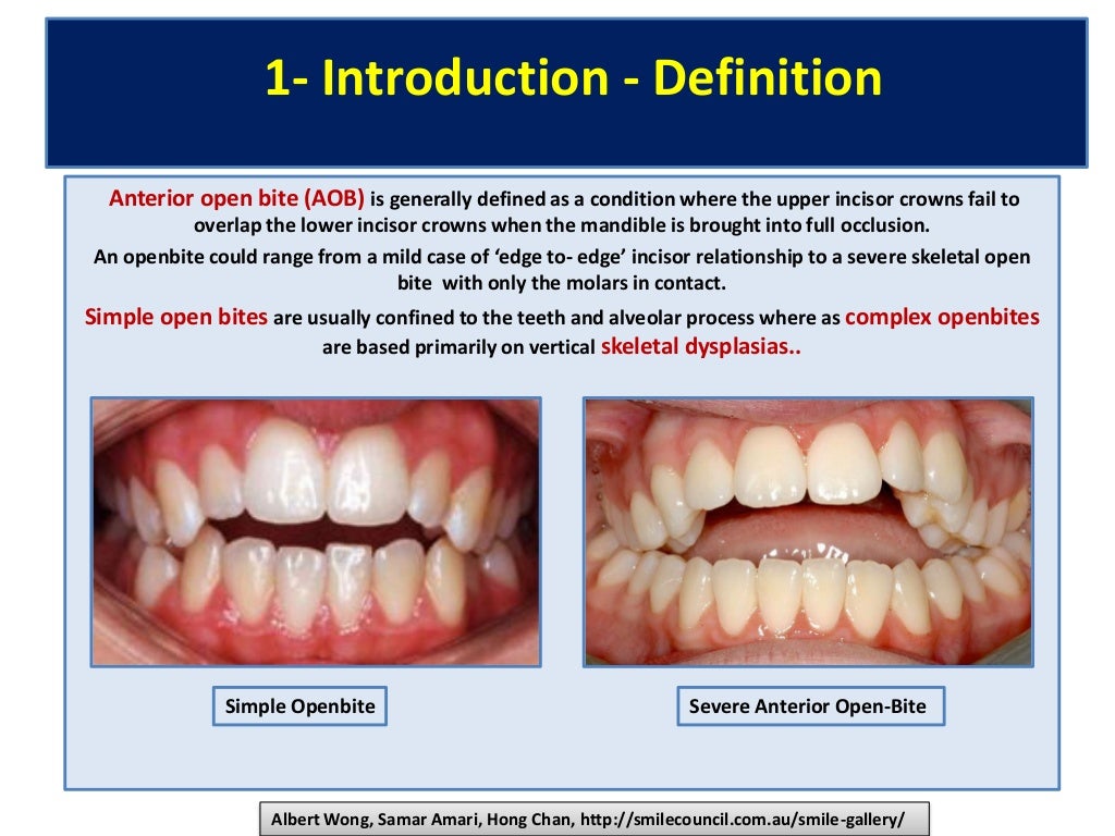Pdf openbitemalocclusion