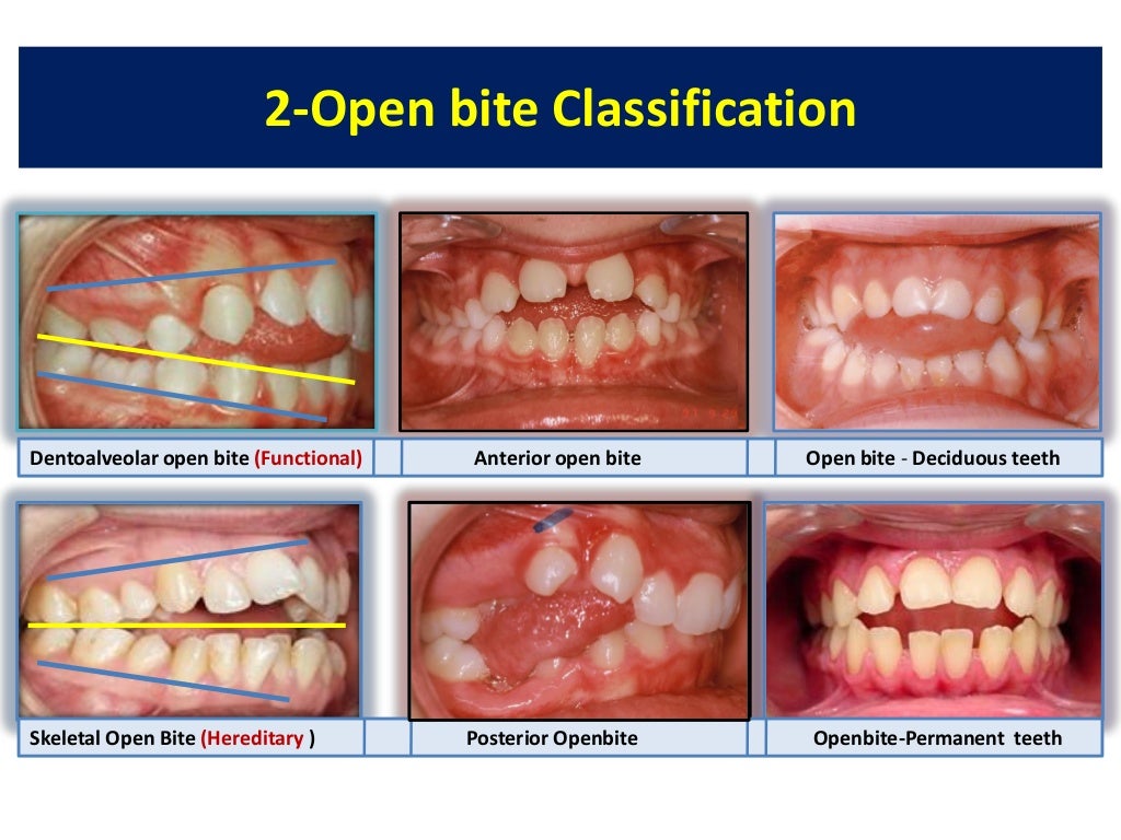 Pdf openbitemalocclusion