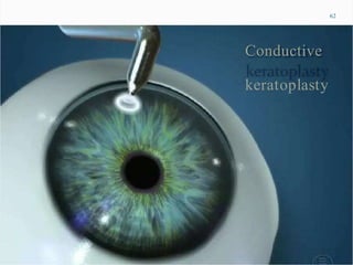 62
Conductive
keratoplasty
 
