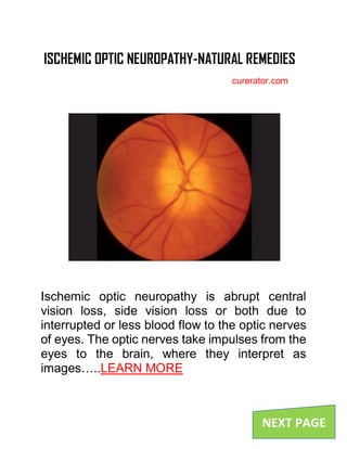 ISCHEMIC OPTIC NEUROPATHY-NATURAL REMEDIES
curerator.com
Ischemic optic neuropathy is abrupt central
vision loss, side vision loss or both due to
interrupted or less blood flow to the optic nerves
of eyes. The optic nerves take impulses from the
eyes to the brain, where they interpret as
images…..LEARN MORE
NEXT PAGE
 