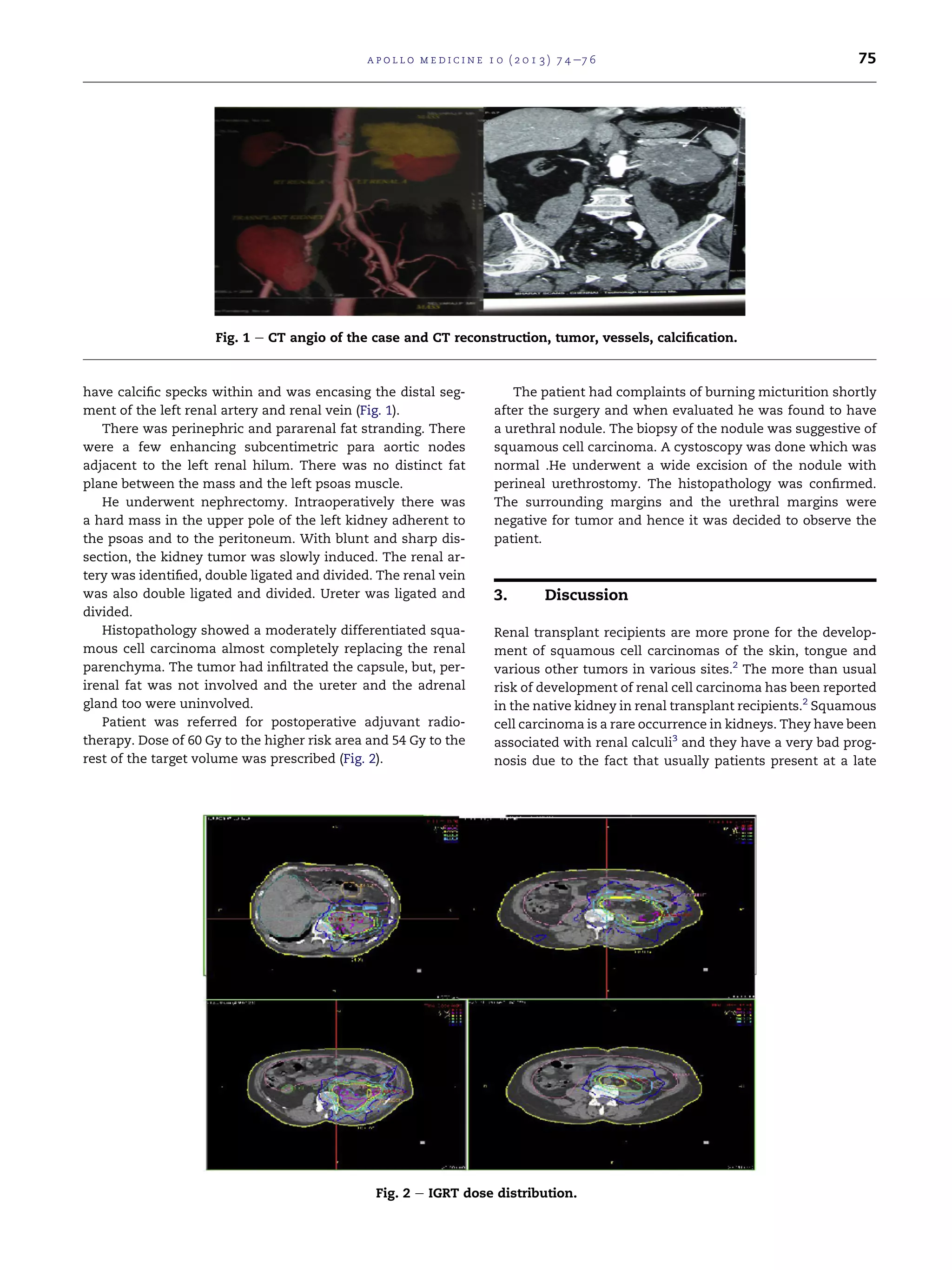 a p o l l o m e d i c i n e 1 0 ( 2 0 1 3 ) 7 4 e7 6

75

Fig. 1 e CT angio of the case and CT reconstruction, tumor, vessels, calciﬁcation.

have calciﬁc specks within and was encasing the distal segment of the left renal artery and renal vein (Fig. 1).
There was perinephric and pararenal fat stranding. There
were a few enhancing subcentimetric para aortic nodes
adjacent to the left renal hilum. There was no distinct fat
plane between the mass and the left psoas muscle.
He underwent nephrectomy. Intraoperatively there was
a hard mass in the upper pole of the left kidney adherent to
the psoas and to the peritoneum. With blunt and sharp dissection, the kidney tumor was slowly induced. The renal artery was identiﬁed, double ligated and divided. The renal vein
was also double ligated and divided. Ureter was ligated and
divided.
Histopathology showed a moderately differentiated squamous cell carcinoma almost completely replacing the renal
parenchyma. The tumor had inﬁltrated the capsule, but, perirenal fat was not involved and the ureter and the adrenal
gland too were uninvolved.
Patient was referred for postoperative adjuvant radiotherapy. Dose of 60 Gy to the higher risk area and 54 Gy to the
rest of the target volume was prescribed (Fig. 2).

The patient had complaints of burning micturition shortly
after the surgery and when evaluated he was found to have
a urethral nodule. The biopsy of the nodule was suggestive of
squamous cell carcinoma. A cystoscopy was done which was
normal .He underwent a wide excision of the nodule with
perineal urethrostomy. The histopathology was conﬁrmed.
The surrounding margins and the urethral margins were
negative for tumor and hence it was decided to observe the
patient.

3.

Discussion

Renal transplant recipients are more prone for the development of squamous cell carcinomas of the skin, tongue and
various other tumors in various sites.2 The more than usual
risk of development of renal cell carcinoma has been reported
in the native kidney in renal transplant recipients.2 Squamous
cell carcinoma is a rare occurrence in kidneys. They have been
associated with renal calculi3 and they have a very bad prognosis due to the fact that usually patients present at a late

Fig. 2 e IGRT dose distribution.

 