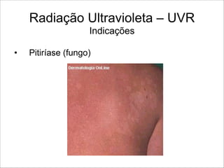 Radiação Ultravioleta – UVR 
Indicações
• Pitiríase (fungo)
 
