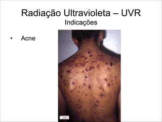 Radiação Ultravioleta – UVR 
Indicações
• Acne
 