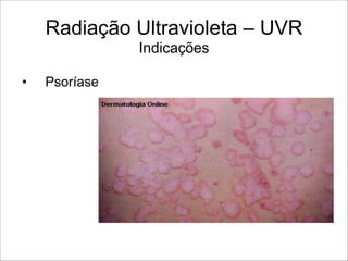 Radiação Ultravioleta – UVR 
Indicações
• Psoríase
 
