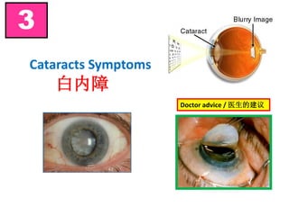 Cataracts Symptoms
白内障
3
Doctor advice / 医生的建议
 