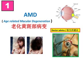 AMD
( Age related Macular Degeneration )
老化黄斑部病变
1
Doctor advice / 医生的建议
 