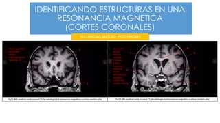 IDENTIFICANDO ESTRUCTURAS EN UNA
RESONANCIA MAGNETICA
(CORTES CORONALES)
1. Núcleo caudado
2. Ventrículo
lateral
3. Lóbulo temporal
izquierdo
Fig12.RM cerebral corte coronal,T1/w-radiología.es/resonancia-magnética-nuclear-cerebro.php Fig13.RM cerebral corte coronal,T1/w-radiología.es/resonancia-magnética-nuclear-cerebro.php
1. Ventrículo
lateral
2. Núcleo
caudado
3. Putamen
4. Lóbulo
temporal
izquierdo
5. Cisura
lateral(Cisura
de Silvio)
6. Cuerpo del
cuerpo calloso
SECUENCIAS ANTERO -POSTERIORES
 