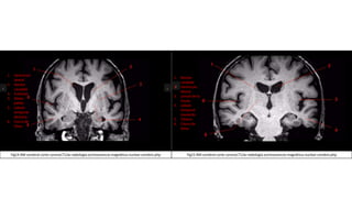 Fig14.RM cerebral corte coronal,T1/w-radiología.es/resonancia-magnética-nuclear-cerebro.php Fig15.RM cerebral corte coronal,T1/w-radiología.es/resonancia-magnética-nuclear-cerebro.php
1. Ventrículo
lateral
2. Núcleo
caudado
3. Putamen
4. Globo
pálido
5. Lóbulo
temporal
derecho
6. Cisura de
Silvio
1. Núcleo
caudado
2. Ventrículo
lateral
3. Lonulo de la
Ínsula
4. Lóbulo
temporal
izquierdo
5. Tálamo
6. Cisura de
Silvio
 