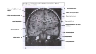 Fig16.RM que muestra la estructura del encéfalo/Neuroanatomía Clínica – Richard S.
Snell,MD.JhD/6ta edición/2006
Fisura longitudinal
Rodilla del cuerpo calloso
Septum pellucidum
Cuerpo del fórnix
Receso infundibular del tercer
ventrículo
Lóbulo temporal
Mesencéfalo
Hueso esfenoides
Asta anterior del ventrículo
lateral
Cabeza del núcleo caudado
Cisura de Silvio
Núcleo lenticular
Tracto óptico
 