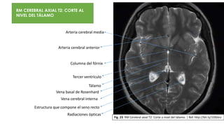 1.- Rodilla del cuerpo calloso
2.- Glándula pineal
3.- Tercer ventrículo
4.- Asta anterior del ventrículo lateral
5.- Asta posterior del ventrículo lateral
6.- Tálamo
7.- Brazo anterior de la cápsula interna
8.- Rodilla de la cápsula interna
9.- Brazo posterior de la cápsula interna
10.- Cabeza del núcleo caudado
11.- Cola del núcleo caudado
12.- Putamen
13.- Globo pálido externo
14.- Globo pálido interno
15.- Lámina medular media
16.- Lámina medular lateral
17.- Cápsula externa
18.- Claustro o antemuro
19.- Cápsula extrema
20.- Cisura de la ínsula
21.- Columna del fórnix
22.- Agujero interventricular de Monroe
23.- Surco calcarino
24.- Radiación óptica
25.- Vena cerebral
RM CEREBRAL AXIAL T2: CORTE AL
NIVEL DEL TÁLAMO
Vena cerebral interna
Tálamo
Tercer ventrículo
Arteria cerebral anterior
Arteria cerebral media
Radiaciones ópticas
Estructura que compone el seno recto
Vena basal de Rosenhard
Columna del fórnix
Fig. 23. RM Cerebral axial T2: Corte a nivel del tálamo. | Ref. http://bit.ly/1O0Jesi
 